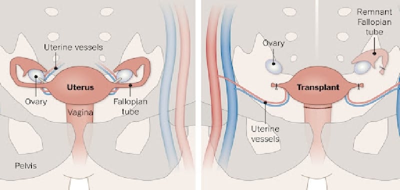 Utero trapiantato, ora obiettivo gravidanza