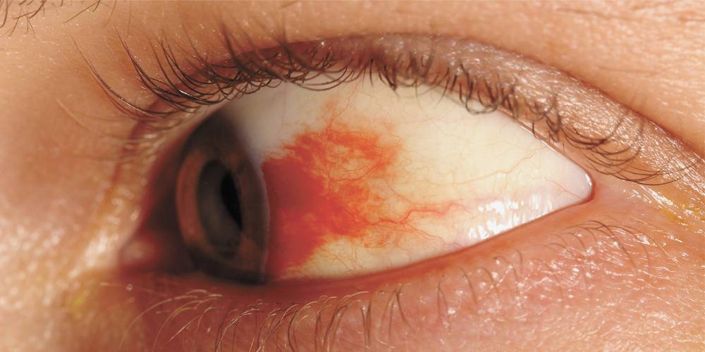 retinopatia-diabetica.jpg